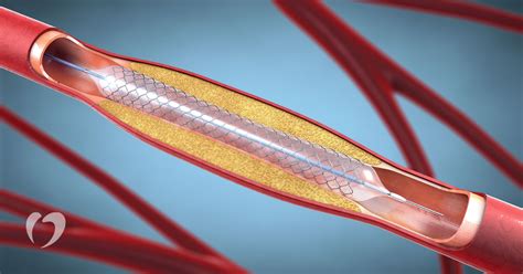 What to Expect During and After Stent Placement | Oklahoma Heart Hospital