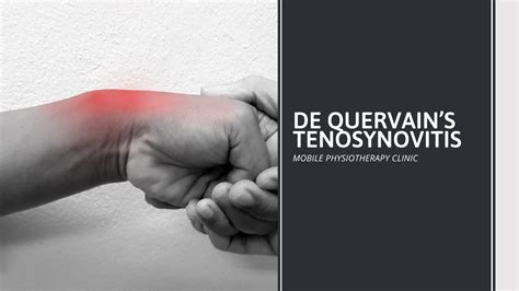 De Quervain’s Tenosynovitis - Samarpan Physiotherapy Clinic Ahmedabad