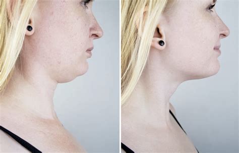 How CoolSculpting Can Reduce Double Chin Fat | Botox, Cosmetic Dermatology, Coolsculpting Los ...