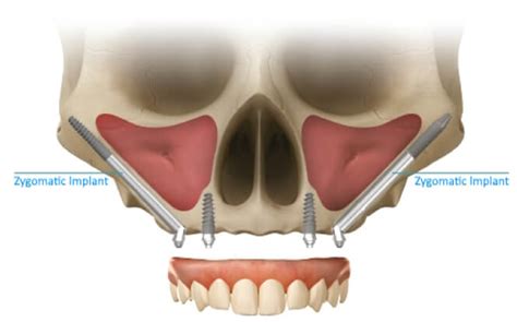 Zygomatic Implants In New York - Dr Kaplansky