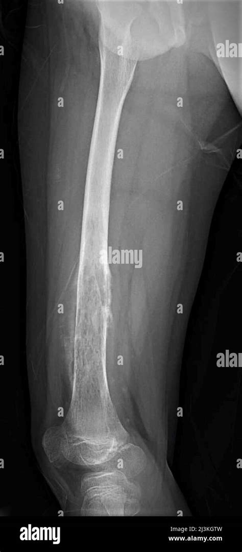 Femur osteosarcoma, X-ray Stock Photo - Alamy