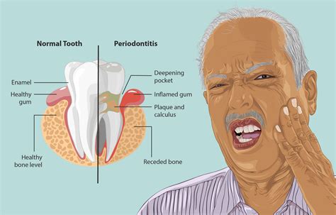 PERIODONTITIS: A COMMON DISEASE