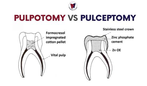 Pulpotomy