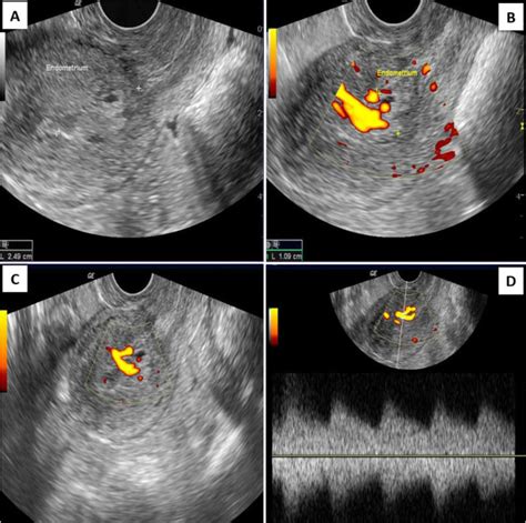 Uterine Cancer Ultrasound Images