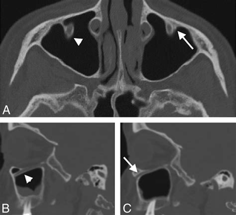 Infraorbital Nerve Function