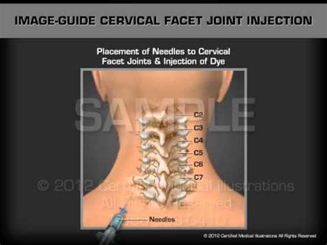 Image Guide Cervical Facet Joint Injection - YouTube