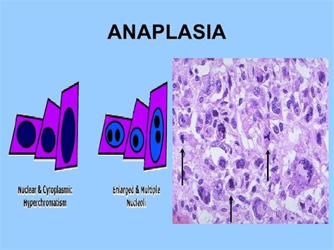 General pathology lecture 7 neoplasms