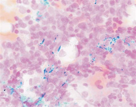 The pattern of iron staining seen in patients who had received... | Download Scientific Diagram