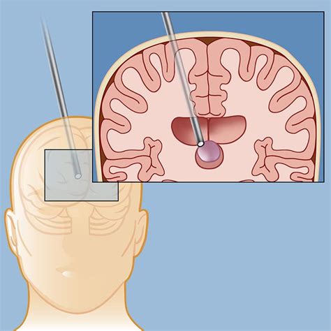 Colloid Cyst Prognosis