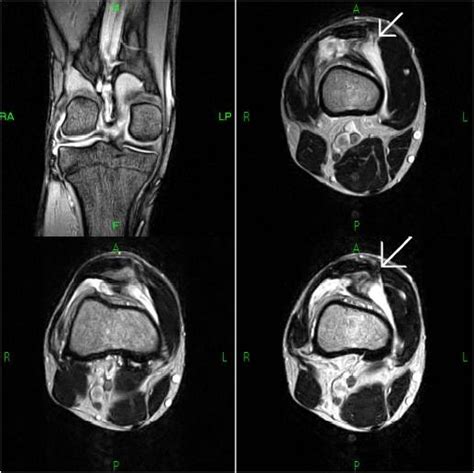 Vastus medialis obliquus (VMO) tendinous tear-MRI - Sumer's Radiology Blog