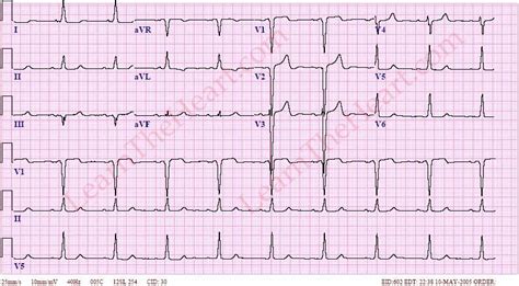 Left Bundle Branch Block Ecg