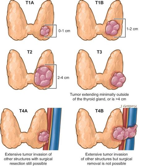 Everything there is to know about thyroid cancer This relatively common ...