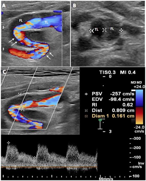 Preoperative Carotid Duplex Ultrasound. (A) There is turbulence (white... | Download Scientific ...