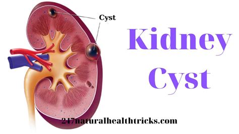 Kidney Cyst - Are cysts on kidneys life threatening? - Can kidney cysts just go away? | 247nht ...