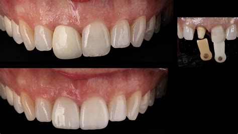 crowns versus veneers teeth