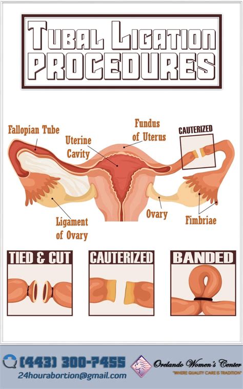 What is Tubal Ligation Methods? in 2020 | Birth control, Fallopian tubes, Birth control methods