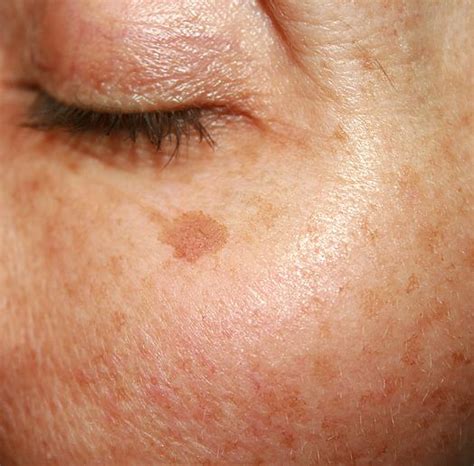 Pigmentation & Sunspots | Skin Concerns | Geelong