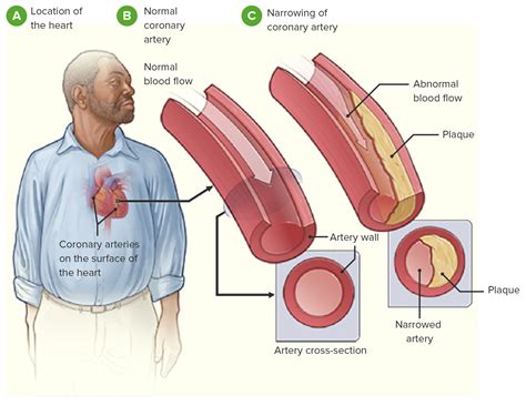 Coronary Heart Disease | Concise Medical Knowledge