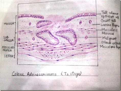 Histology Slides Database: Colonic Adenocarcinoma hand made histopathology diagram