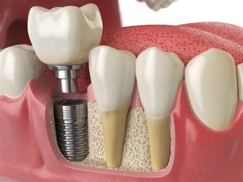 Dental Implants - Borough Dental Care Call Now on 0207 407 3883