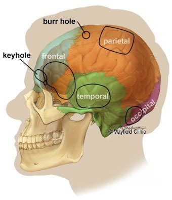 Craniotomy Surgery In India | Brain Surgery In India