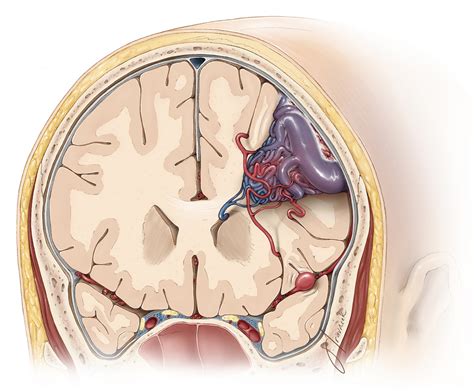 Arteriovenous Malformation Mri