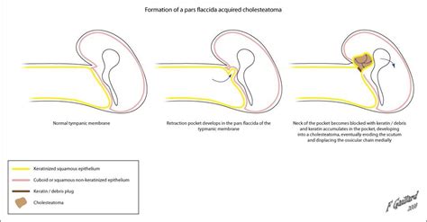 Formation of a cholesteatoma | Radiology Case | Radiopaedia.org | Medical illustration ...