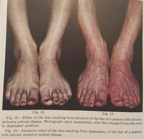 Vasospastic disorders - From Raynaud's to Acrocyanosis