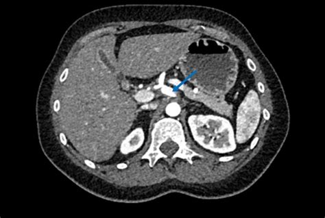 Celiac artery aneurysm causing an acute abdomen | BMJ Case Reports