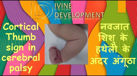 cortical thumb sign in hindi - What does it mean and is it a sign of ...