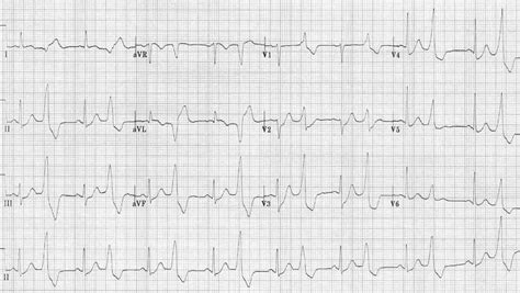 Premature Ventricular Complex (PVC) • LITFL • ECG Library Diagnosis