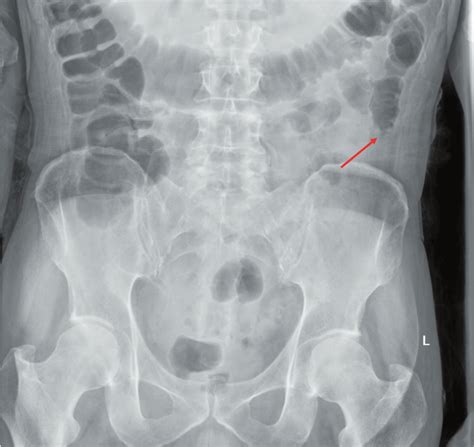 Abdominal radiograph demonstrating the "colon cutoff" sign, indicated ...