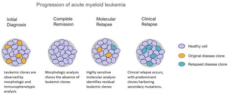 Acute Myeloid Leukemia 2024 - Elie Nicola