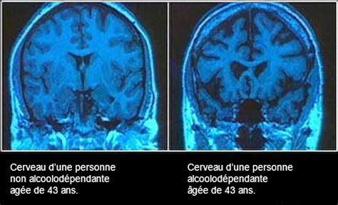 Alcoolisme : ces régions du cerveau qui récupèrent après une période d ...