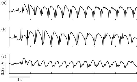 Absence Seizure - EEG, Prognosis, Medication