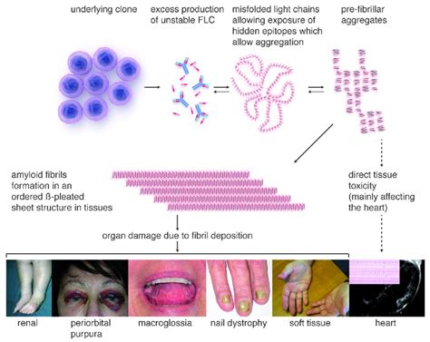 Amyloidosis - Stepwards