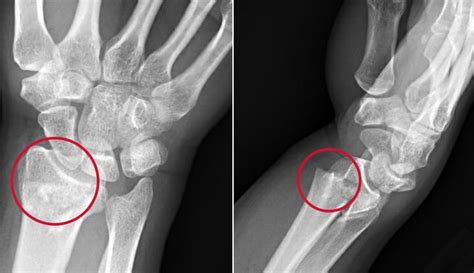 Colles Fracture: Symptoms, Causes & Treatment