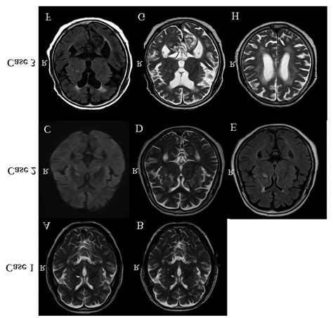 Magnetic resonance image findings for the three hemichorea-hemiballism... | Download Scientific ...