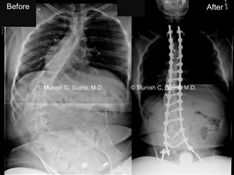 Spina Bifida | Munish C. Gupta, M.D.