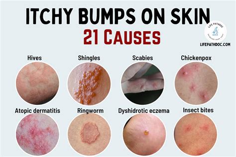 Itchy Bumps On Skin: 21 Causes, Pictures, And Treatment, 58% OFF