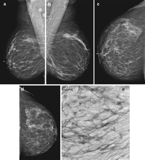 12 ( a – e ) This 49-year-old woman felt a lump under her right areola.... | Download Scientific ...