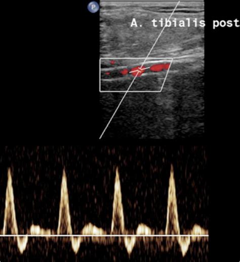 Duplex ultrasound and PW-Doppler sonography of right posterior tibial ...