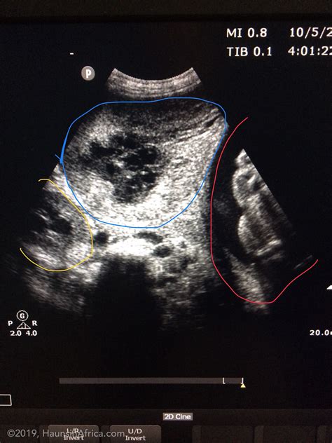 Dermoid Ovarian Cyst - The Hauns in Africa