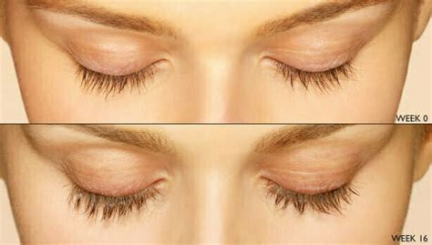 Hagerstown Latisse Eyelash Enhancement - Dr. Garazo