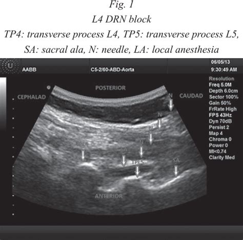 Figure 1 from ULTRASOUND GUIDED DORSAL RAMUS NERVE BLOCK FOR REDUCTION OF POSTOPERATIVE PAIN IN ...