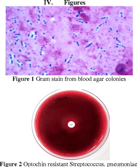 Figure 1 from Optochin Resistance-Streptococcus pneumoniae in case of ...