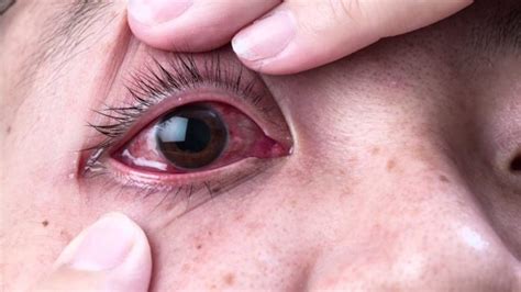 Kinds of eye infections symptoms complications and ways to prevent them