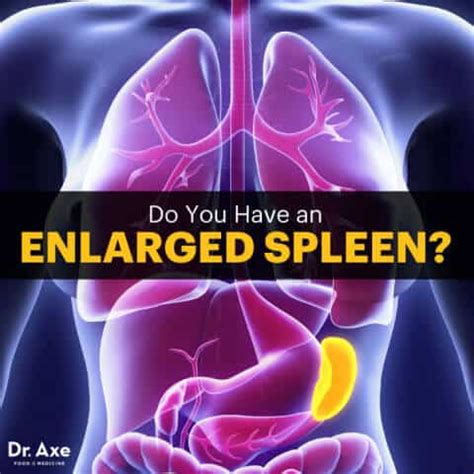 Enlarged Spleen Symptoms, Warning Signs + 5 Treatments - Dr. Axe