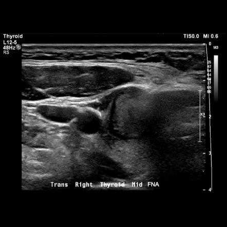 Assessment of thyroid lesions (ultrasound) | Radiology Reference ...