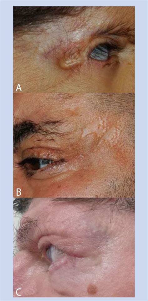 Figure 8 from Barber-Say syndrome and Ablepharon-Macrostomia syndrome: An overview. | Semantic ...